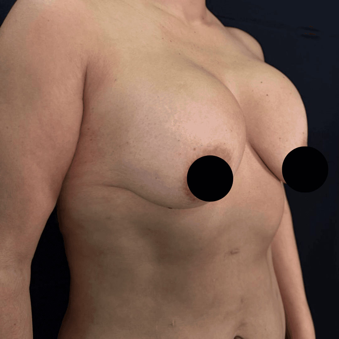 Antes cirugia mamaria