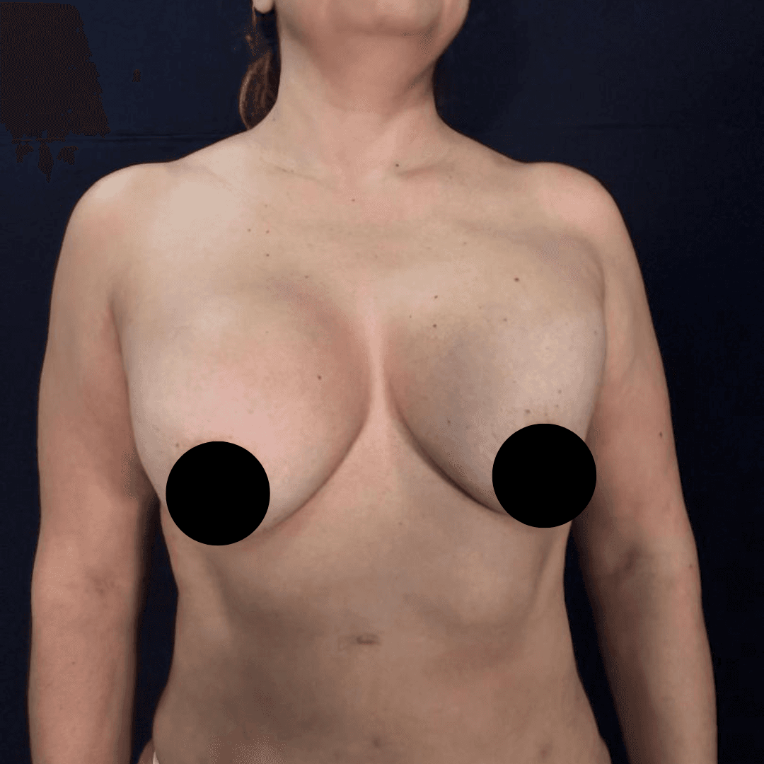 Antes cirugia mamaria