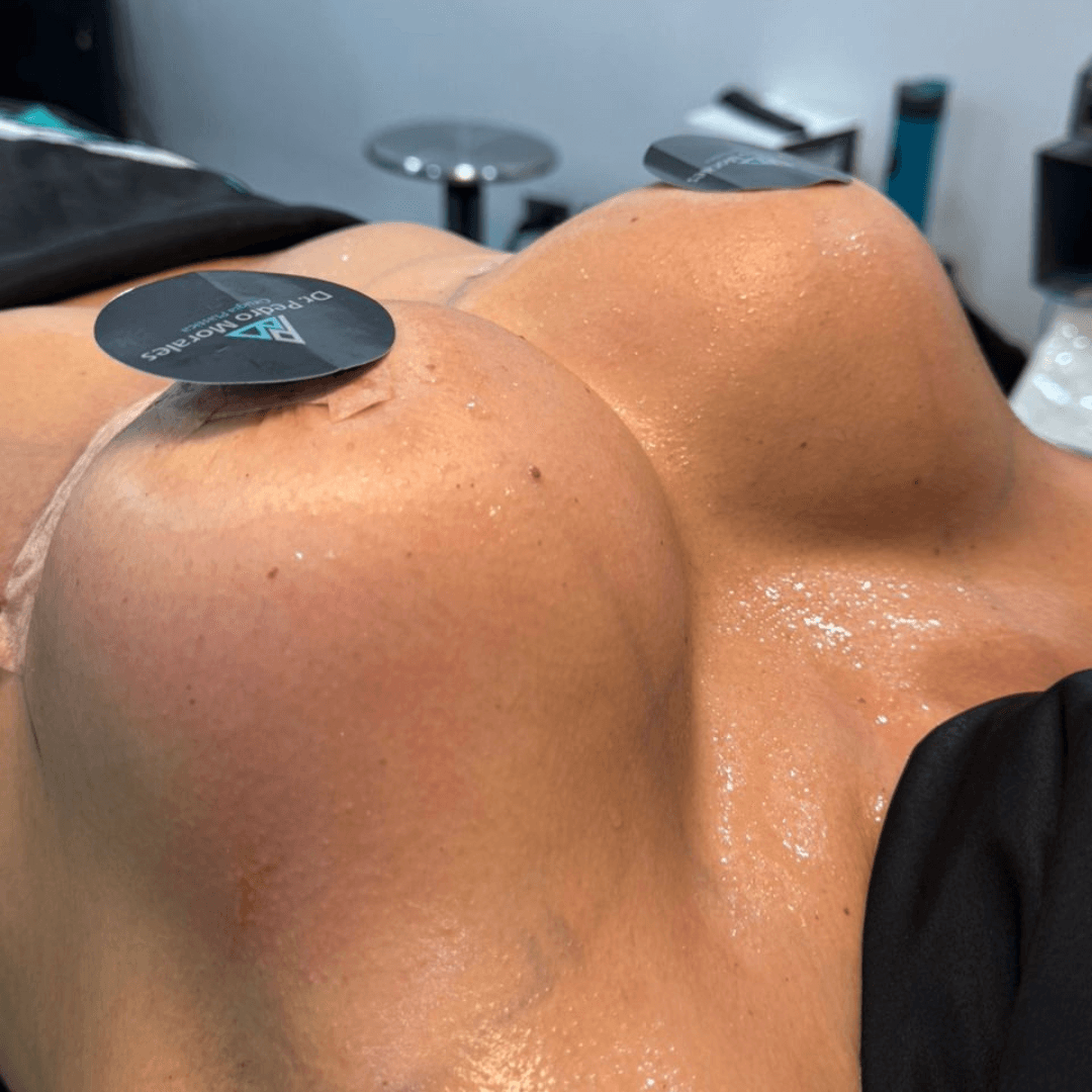 Después cirugia mamaria