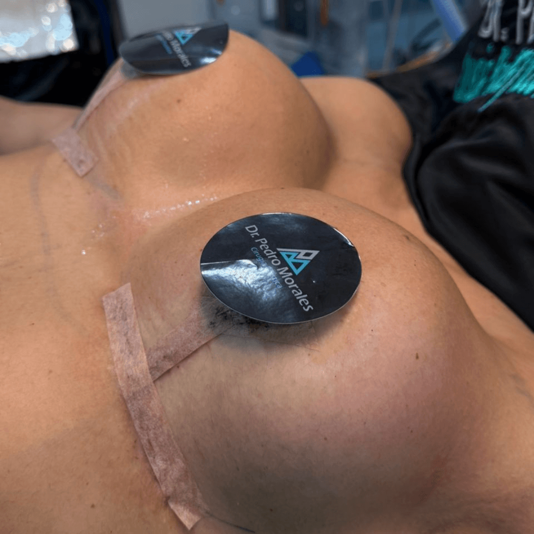 Después cirugia mamaria