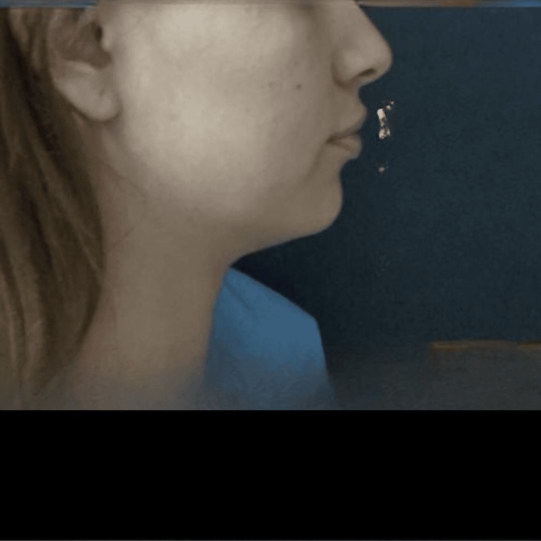 Evaluacion previa lipoescultura de papada