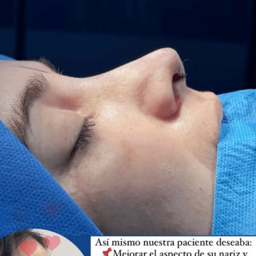 Rinoplastia ultrasonica