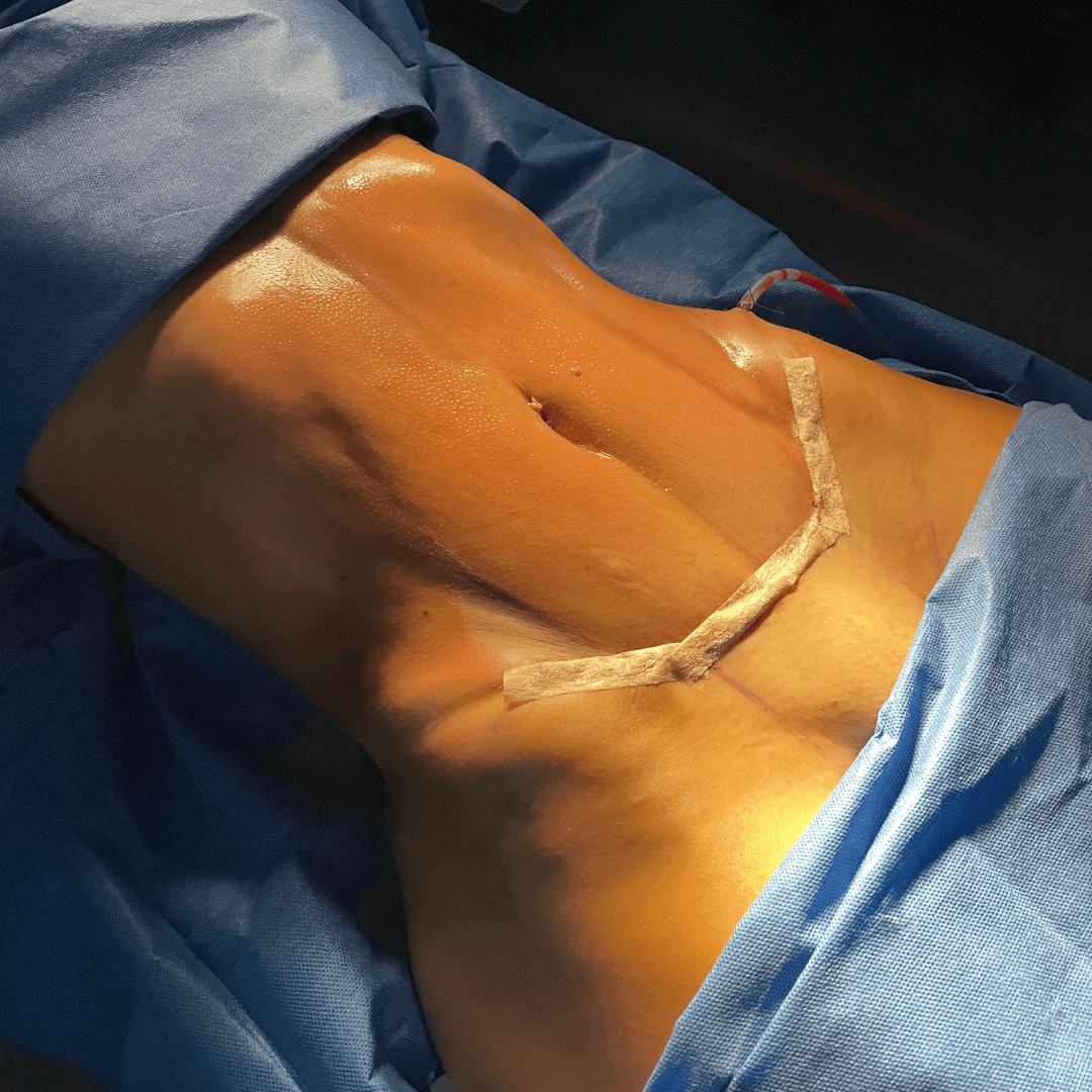 Resultado contorno corporal y Lipo HD