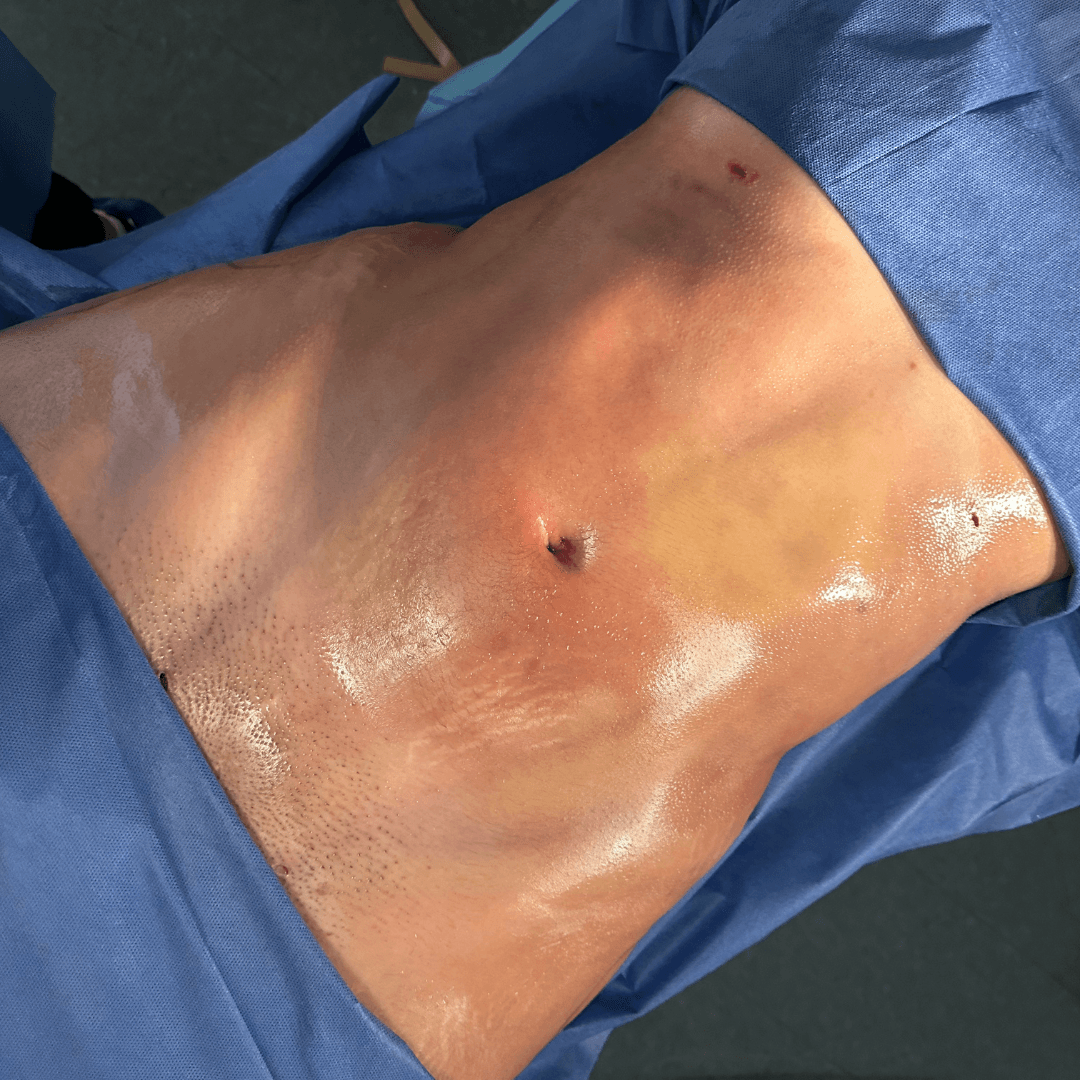 Resultado contorno corporal y Lipo HD