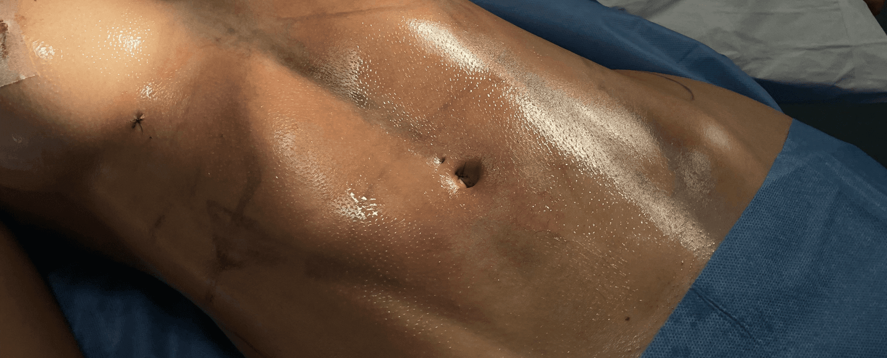 Contorno corporal y Lipo HD