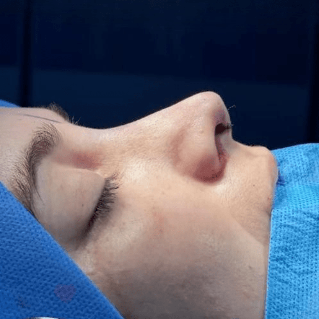 Rinoplastia ultrasonica