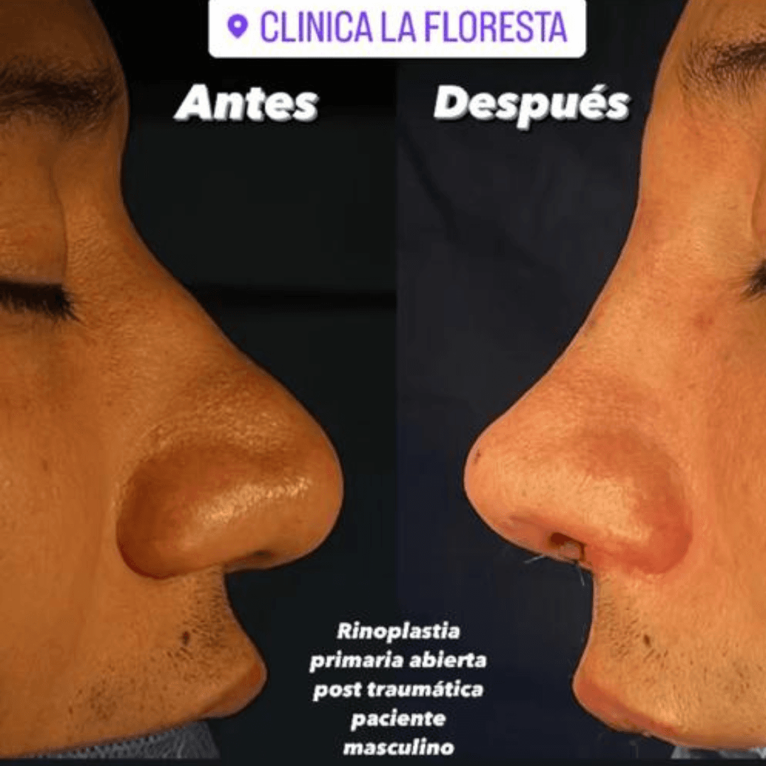 Rinoplastia en Punto Fijo Dr Pedro Morales